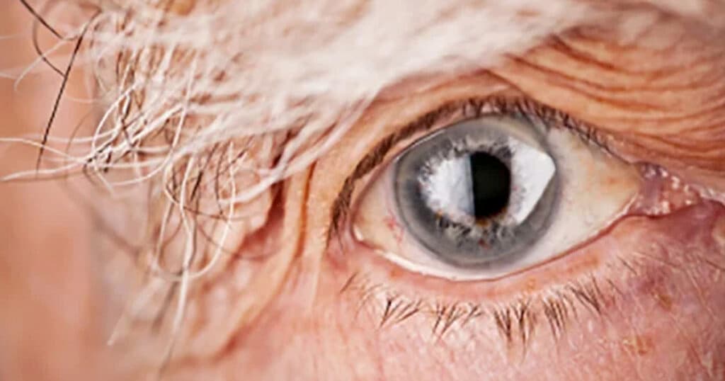 Degeneração Macular: causas, sintomas e tratamento com injeção intravítrea